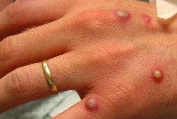 Varíola dos macacos confirmada na cidade